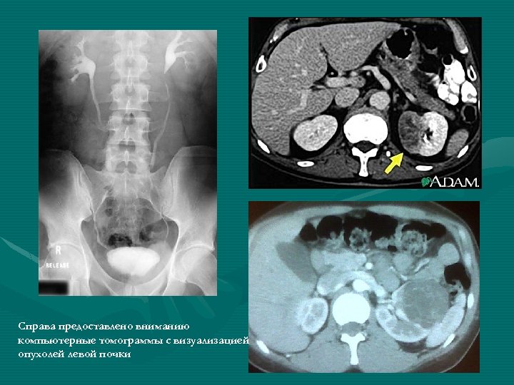 Справа предоставлено вниманию компьютерные томограммы с визуализацией опухолей левой почки 