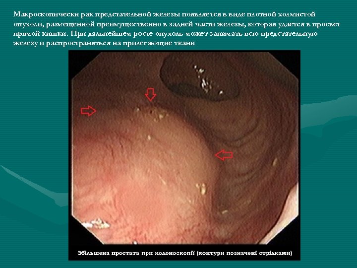 Макроскопически рак предстательной железы появляется в виде плотной холмистой опухоли, размещенной преимущественно в задней