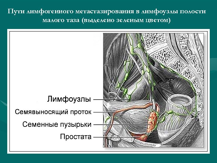 Пути лимфогенного метастазирования в лимфоузлы полости малого таза (выделено зеленым цветом) 