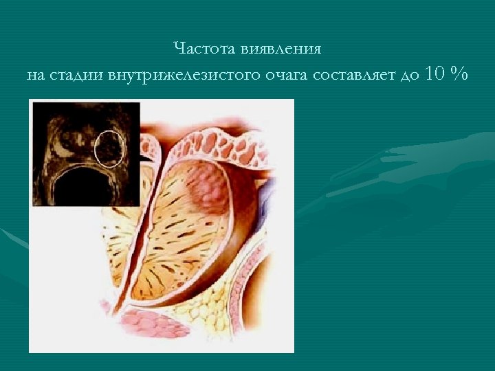 Частота виявления на стадии внутрижелезистого очага составляет до 10 % 