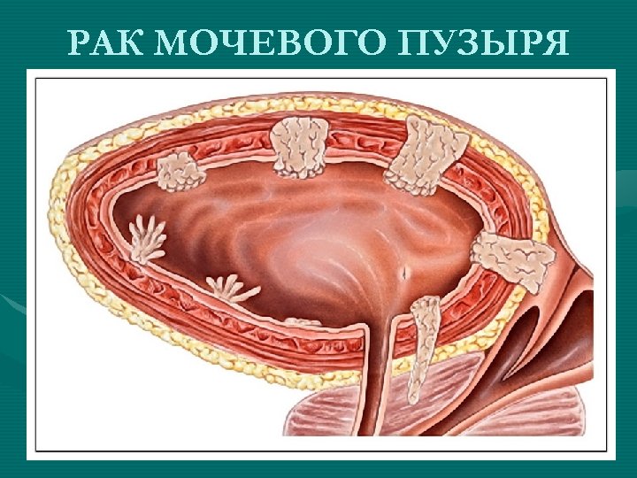 РАК МОЧЕВОГО ПУЗЫРЯ 