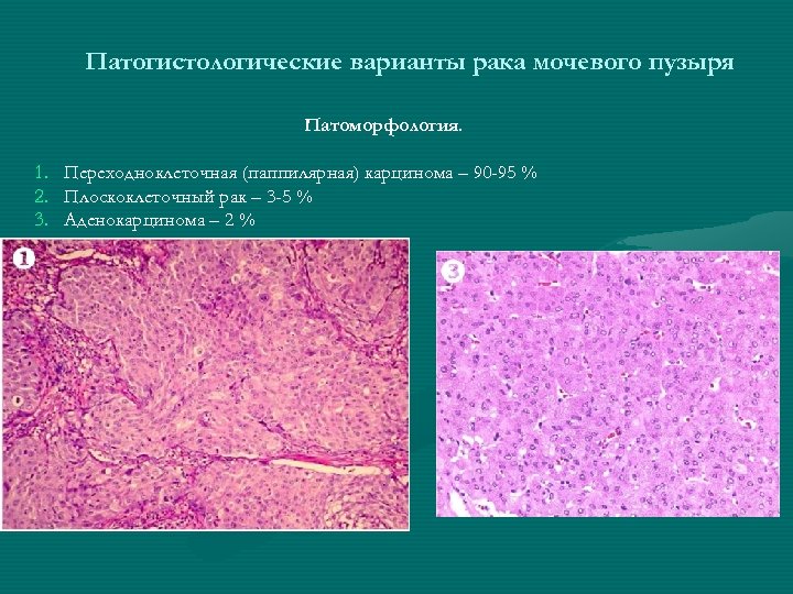Патогистологические варианты рака мочевого пузыря Патоморфология. 1. 2. 3. Переходноклеточная (паппилярная) карцинома – 90