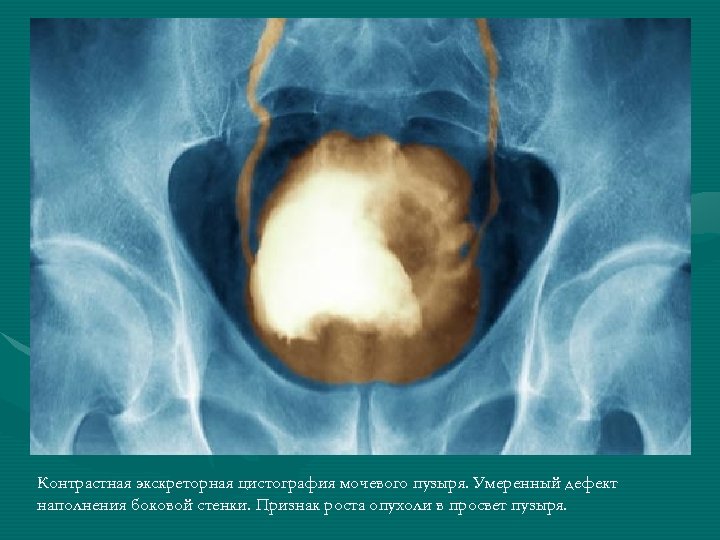 Контрастная экскреторная цистография мочевого пузыря. Умеренный дефект наполнения боковой стенки. Признак роста опухоли в