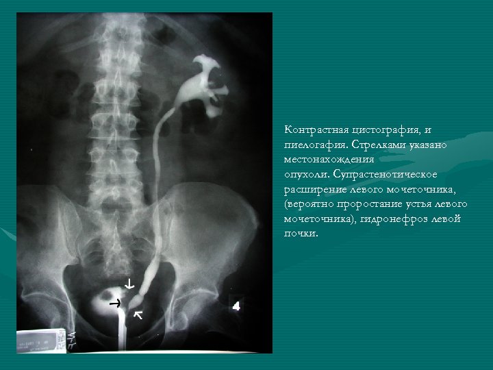 Травмы мочеточника презентация