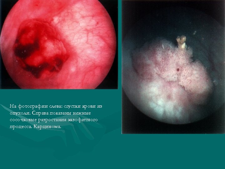 На фотографии слева: сгустки крови из опухоли. Справа показаны нежные сосочковые разростания экзофитного процесса.