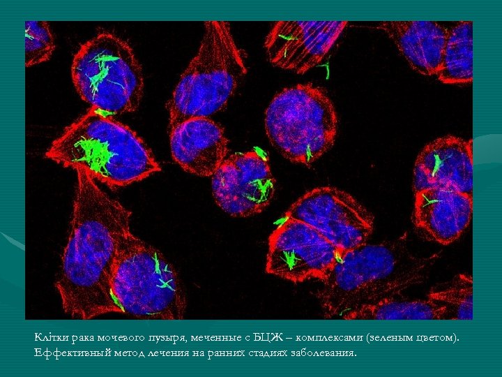 Клітки рака мочевого пузыря, меченные с БЦЖ – комплексами (зеленым цветом). Еффективный метод лечения