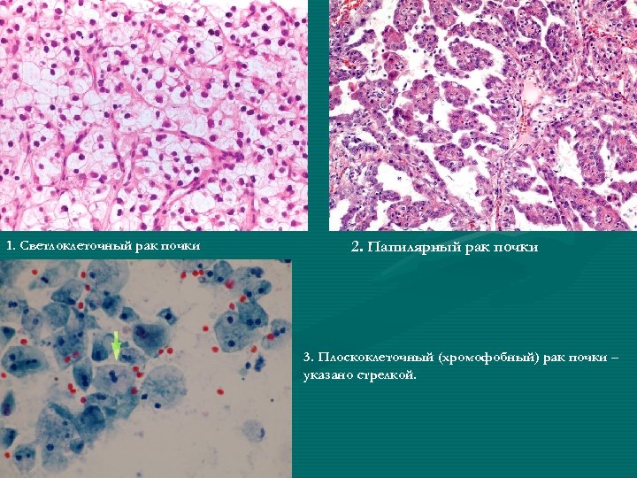 1. Светлоклеточный рак почки 2. Папилярный рак почки 3. Плоскоклеточный (хромофобный) рак почки –