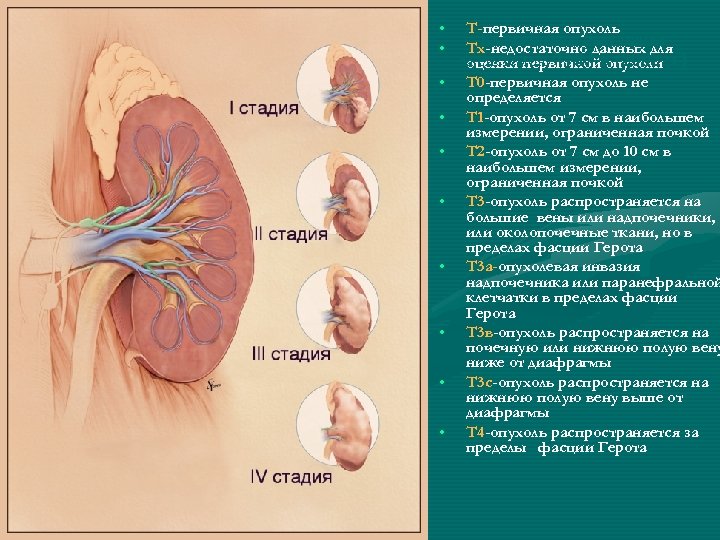  • • • Т-первичная опухоль Класифікація раку нирки Тх-недостаточно данных для за системою