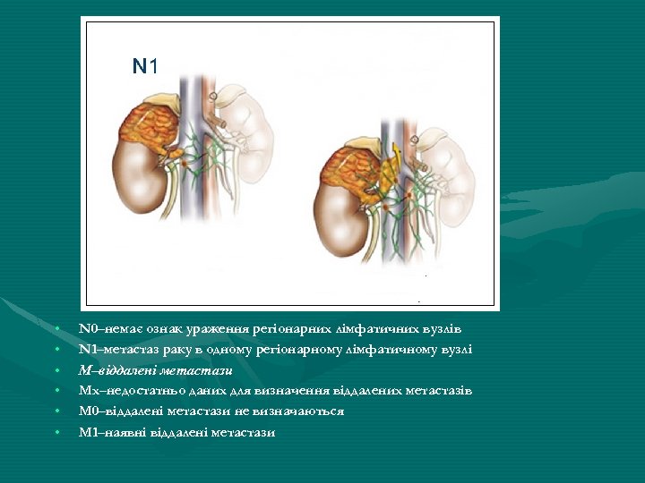  • • • N 0–немає ознак ураження регіонарних лімфатичних вузлів N 1–метастаз раку