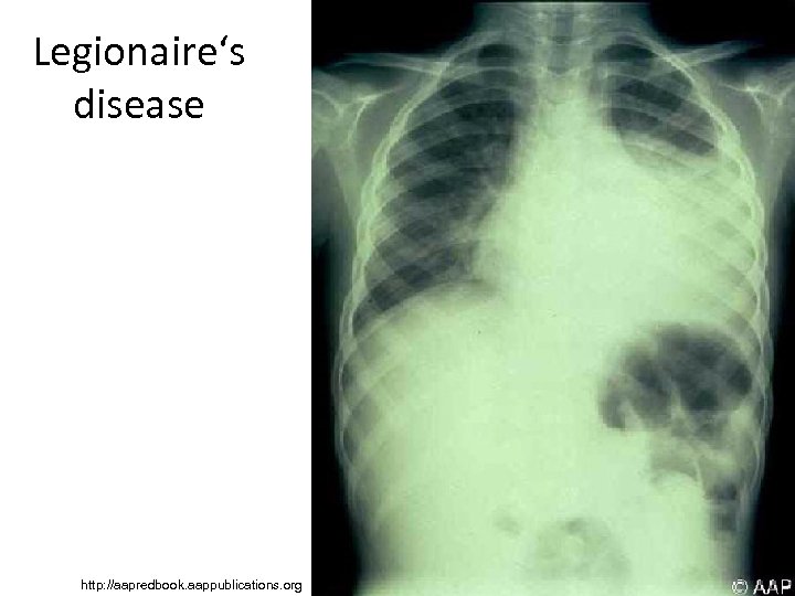 Legionaire‘s disease http: //aapredbook. aappublications. org 