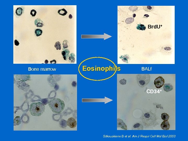 Brd. U+ Bone marrow Eosinophils BALf CD 34+ Sitkauskiene B et al. Am J