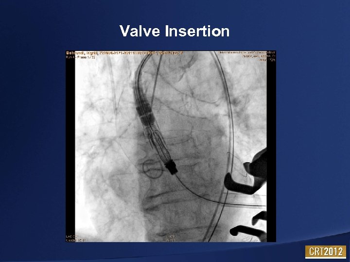 Valve Insertion 