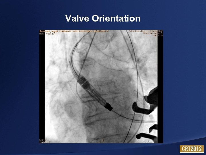 Valve Orientation 