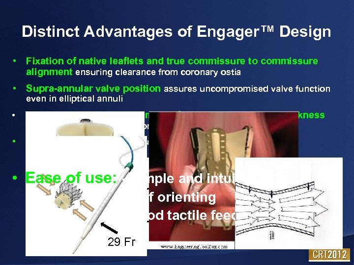Distinct Advantages of Engager™ Design • Fixation of native leaflets and true commissure to