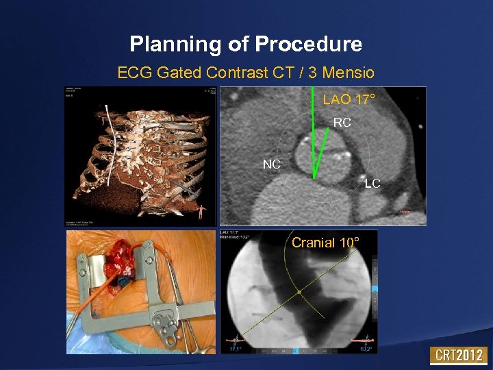 Planning of Procedure ECG Gated Contrast CT / 3 Mensio LAO 17° RC NC
