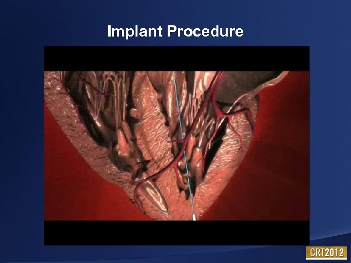 Implant Procedure 