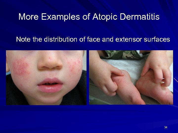 More Examples of Atopic Dermatitis Note the distribution of face and extensor surfaces 34