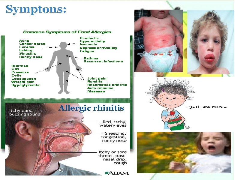 Symptons: Allergic rhinitis 