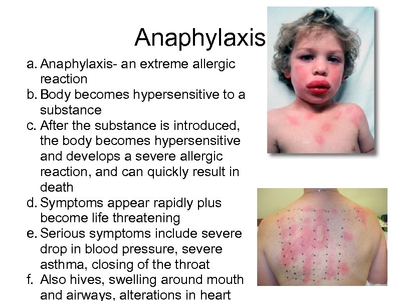Anaphylaxis a. Anaphylaxis- an extreme allergic reaction b. Body becomes hypersensitive to a substance