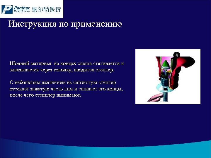 Инструкция по применению Шовный материал на концах слегка стягивается и завязывается через головку, вводится