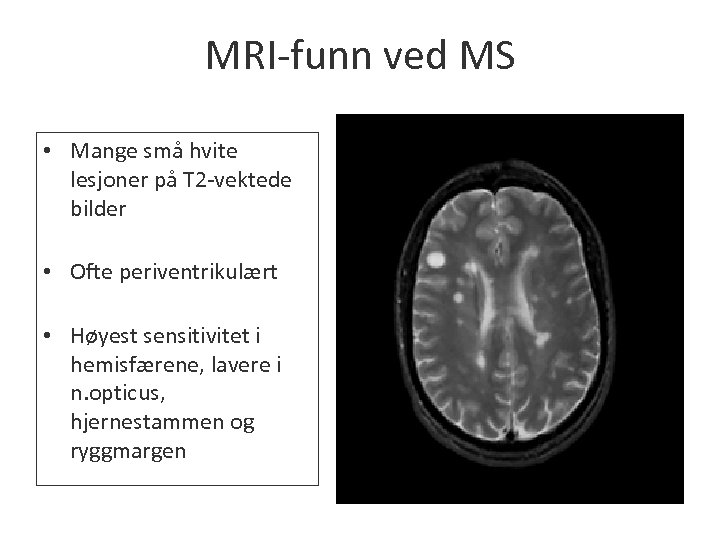 MRI-funn ved MS • Mange små hvite lesjoner på T 2 -vektede bilder •