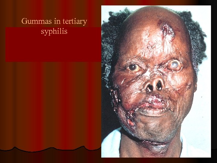 Gummas in tertiary syphilis 