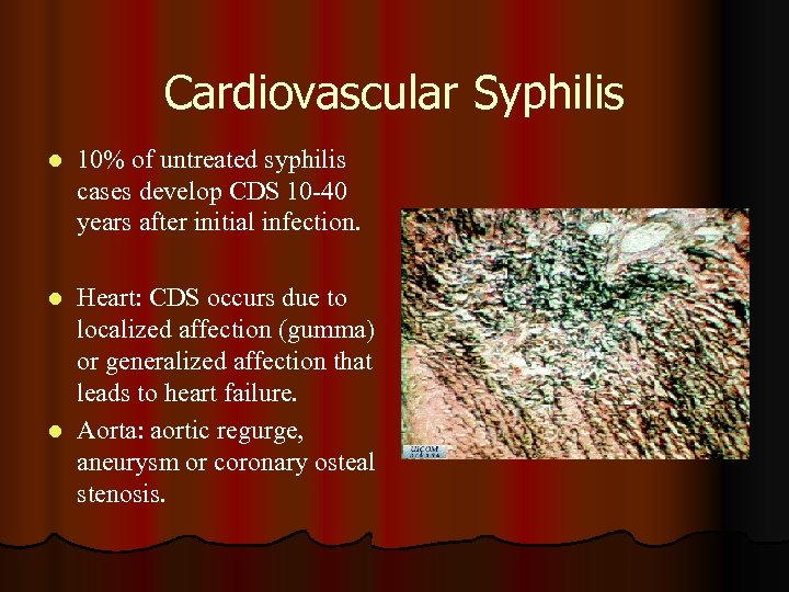 Cardiovascular Syphilis l 10% of untreated syphilis cases develop CDS 10 -40 years after