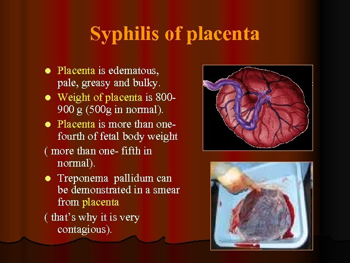 Syphilis of placenta Placenta is edematous, pale, greasy and bulky. l Weight of placenta