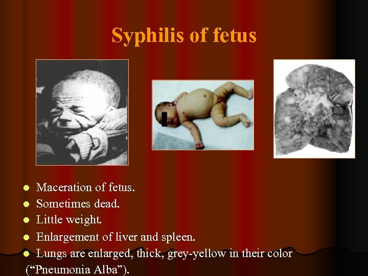 Syphilis of fetus Maceration of fetus. l Sometimes dead. l Little weight. l Enlargement