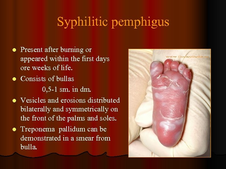Syphilitic pemphigus l l Present after burning or appeared within the first days ore