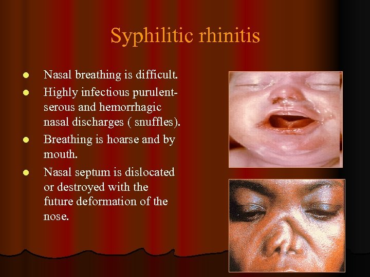 Syphilitic rhinitis l l Nasal breathing is difficult. Highly infectious purulentserous and hemorrhagic nasal