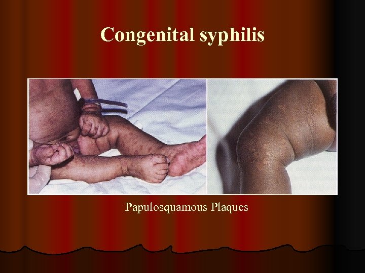 Congenital syphilis Papulosquamous Plaques 