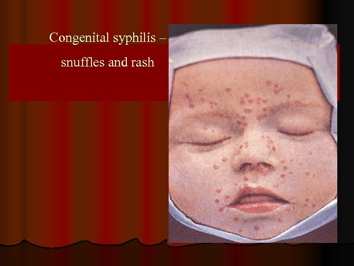 Congenital syphilis – snuffles and rash 