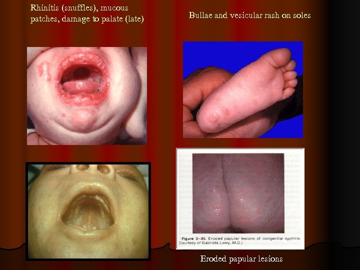 Rhinitis (snuffles), mucous patches, damage to palate (late) Bullae and vesicular rash on soles