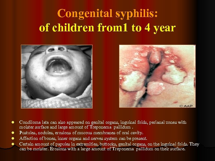 Congenital syphilis: of children from 1 to 4 year l l Condiloma lata can