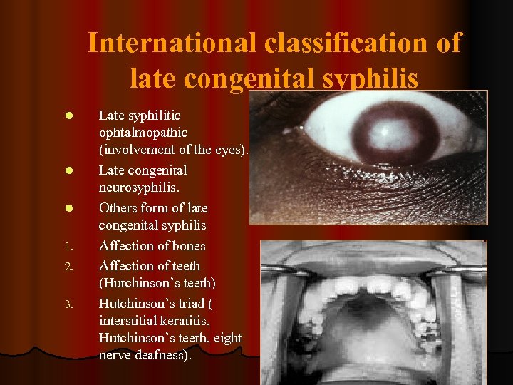 International classification of late congenital syphilis l l l 1. 2. 3. Late syphilitic