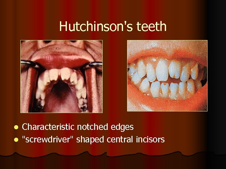 Hutchinson's teeth Characteristic notched edges l 