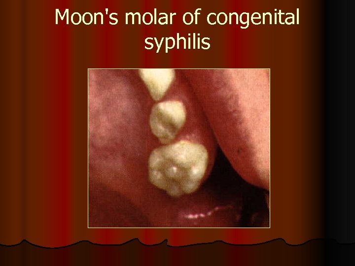 Moon's molar of congenital syphilis 