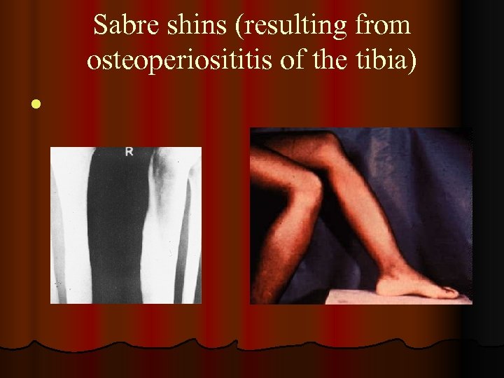 Sabre shins (resulting from osteoperiosititis of the tibia) l 