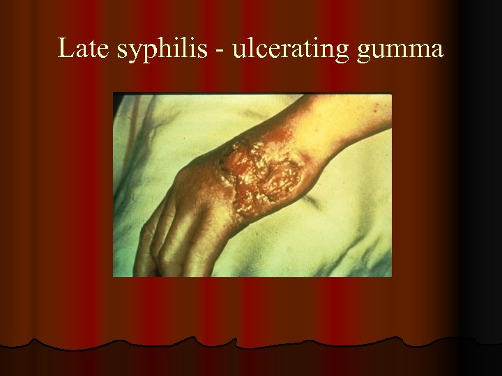 Late syphilis - ulcerating gumma 