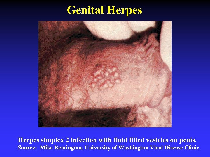 Genital Herpes simplex 2 infection with fluid filled vesicles on penis. Source: Mike Remington,