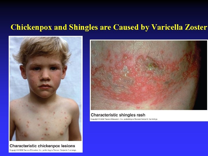 Chickenpox and Shingles are Caused by Varicella Zoster 