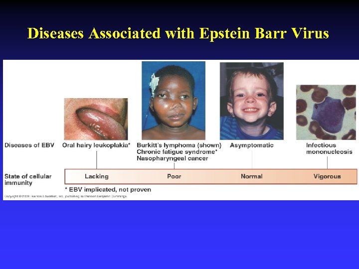 Diseases Associated with Epstein Barr Virus 