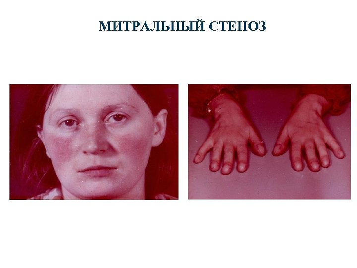 МИТРАЛЬНЫЙ СТЕНОЗ 