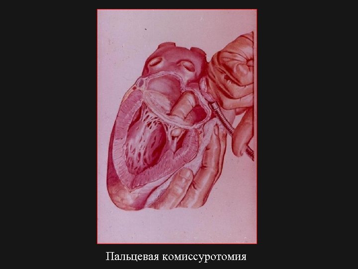 Пальцевая комиссуротомия 