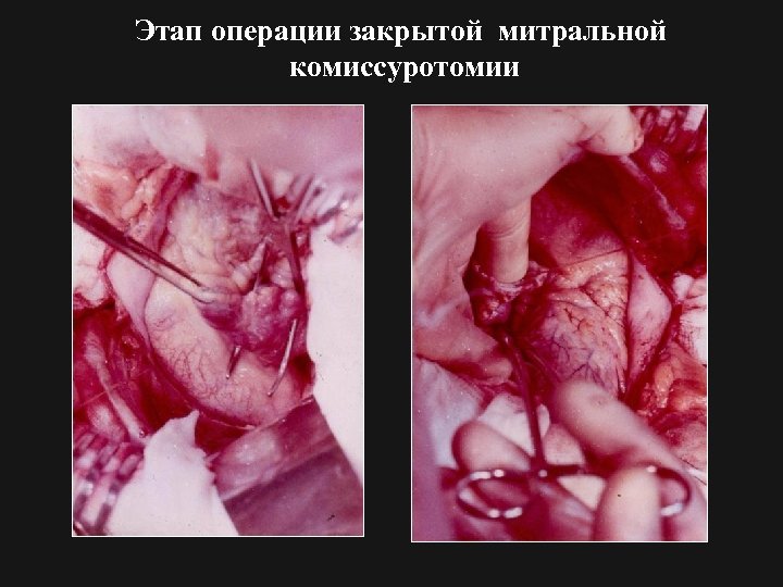 Этап операции закрытой митральной комиссуротомии 