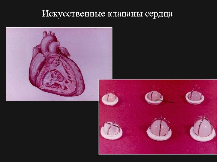 Искусственные клапаны сердца 