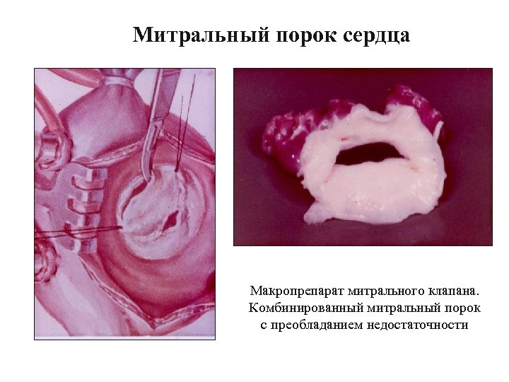 Митральный порок сердца Макропрепарат митрального клапана. Комбинированный митральный порок с преобладанием недостаточности Митральный стеноз.