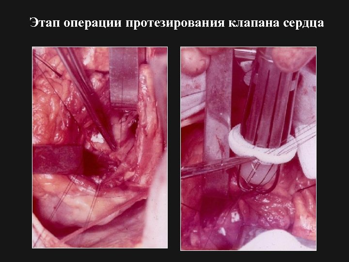 Этап операции протезирования клапана сердца 