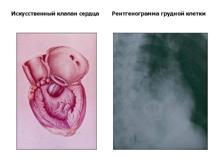 Искусственный клапан сердца Рентгенограмма грудной клетки 